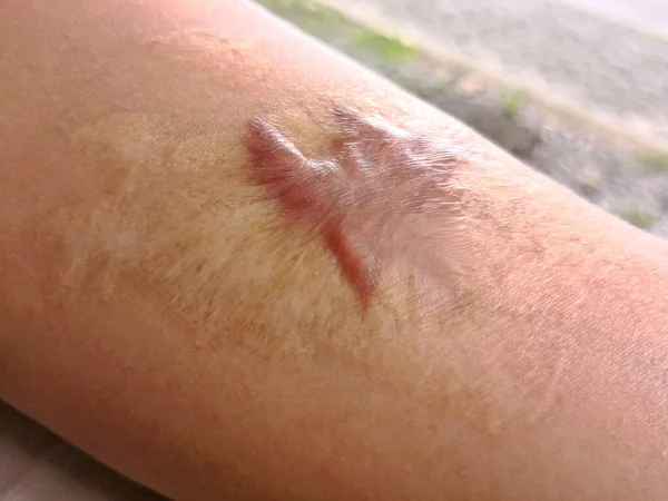 Close Keloid Litteken Hypertrofische Litteken Huid Van Man Arm Ongeval — Stockfoto