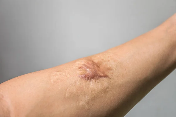 Κοντινό Πλάνο Keloid Ουλή Hypertrophic Ουλή Στο Ανθρώπινο Δέρμα Βραχίονα — Φωτογραφία Αρχείου