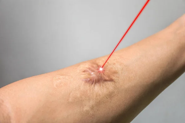 Mannenarm Laserstraal Tijdens Littekenverwijderingstechnologie Van Huidbehandelconcept — Stockfoto