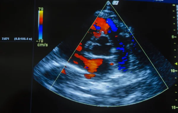 Obraz USG serca na ekranie komputera. — Zdjęcie stockowe