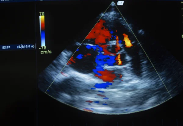 Image d'échographie cardiaque sur un écran d'ordinateur . — Photo