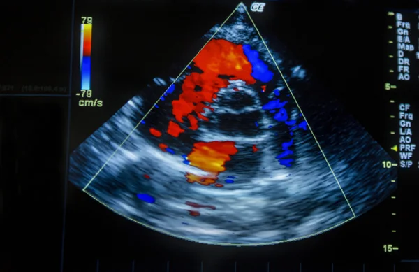 Image d'échographie cardiaque sur un écran d'ordinateur . — Photo