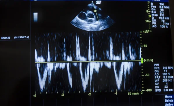 Obraz USG serca na ekranie komputera i inwalida. — Zdjęcie stockowe