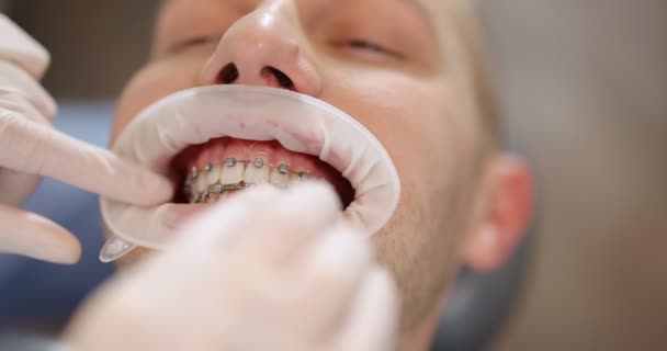 Paziente con apparecchio dentale durante un trattamento ortodontico — Video Stock