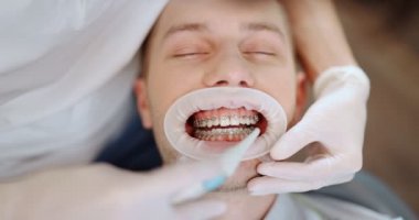 Ortodonti tedavisi sırasında diş teli takan hasta.