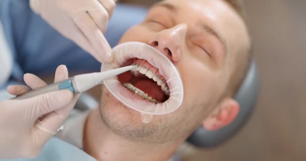 Paciente con aparatos dentales durante un tratamiento de ortodoncia — Vídeos de Stock