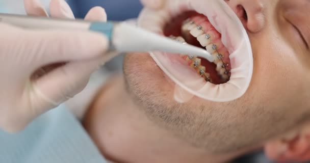 Pasien dengan kawat gigi selama perawatan ortodontik — Stok Video