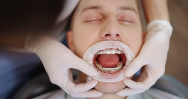 Patiënt met tandbeugels tijdens een orthodontische behandeling — Stockvideo