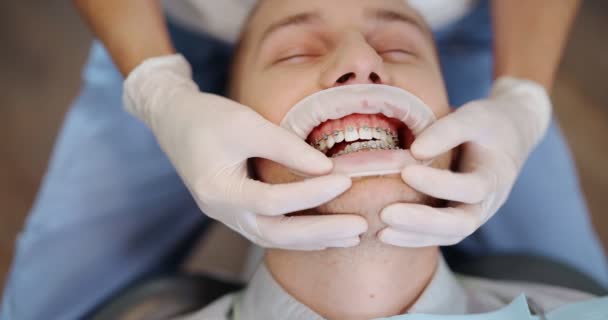 Paziente con apparecchio dentale durante un trattamento ortodontico — Video Stock