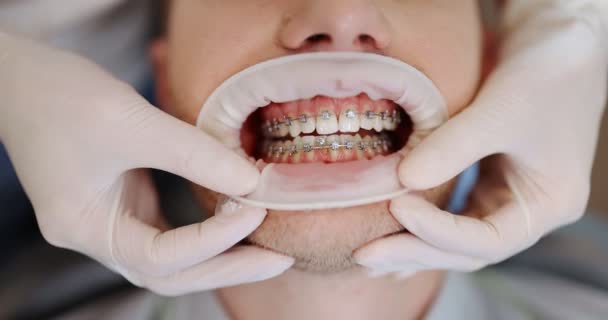 Paciente con aparatos dentales durante un tratamiento de ortodoncia — Vídeos de Stock