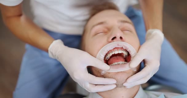 Pacjent z aparatem ortodontycznym podczas leczenia ortodontycznego — Wideo stockowe
