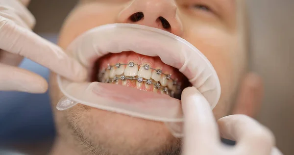 Пациент с зубными скобками во время ортодонтического лечения — стоковое фото