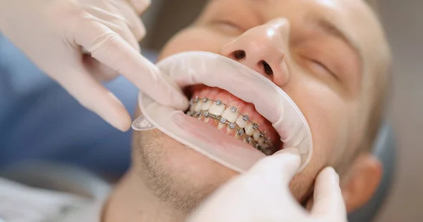 Ortodonti tedavisi sırasında diş teli takan hasta. — Stok fotoğraf