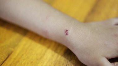 Çocukluk yarası açık tende küçük bir leke olduğunu gösteriyor.