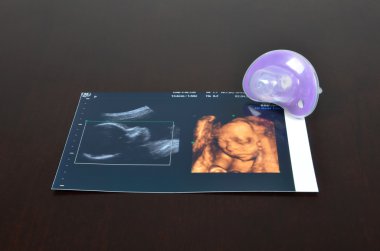 Bebek emziği ultrason görüntüleri