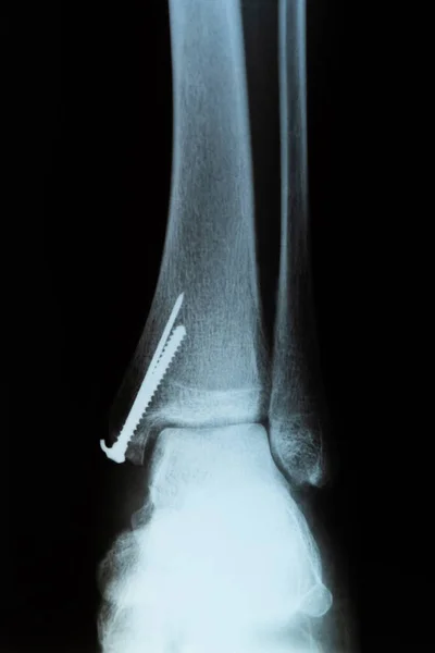 Front view of X-RAY scan. Human leg with metal screw after the surgery.