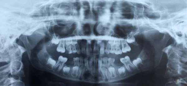 Radiografía Dental Niño —  Fotos de Stock