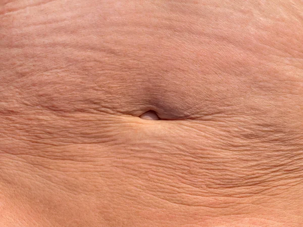 A womans flabby stomach with wrinkles after losing weight. The concept of plastic surgery — Stock Photo, Image