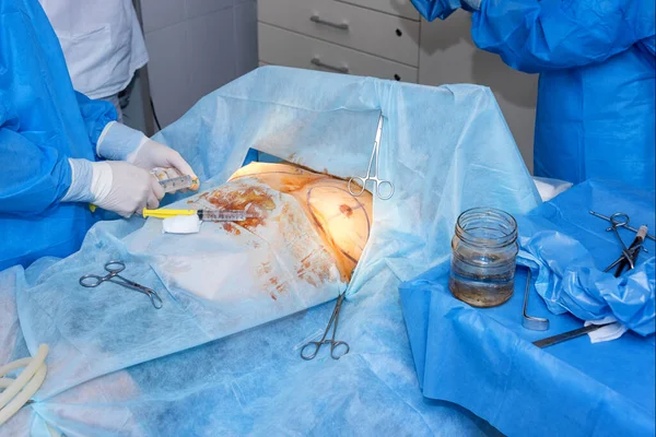 2018 Ucrania Kiev Clínica Cirugía Plástica Equipo Quirúrgico Realizando Cirugía — Foto de Stock