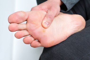Nasırlı ayak, nasırlı nasırlı ve kuru derili, siğil uçlu. Verrucas papilloma callus virüsü, ayak derisinde hastalık. Patlamış mısırlı sağlıksız ayak bacağı. Adam tedaviden önce dinginlik gösteriyor.