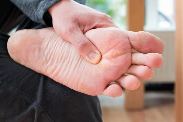 Foot with corns, calluses and dry skin, wart plantar verrucas. Verrucas papilloma callus virus, desease on foot skin. Unhealthy foot leg with corn close up. Man shows callosity before treatment.