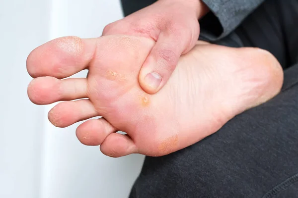 Foot with corns, calluses and dry skin, wart plantar verrucas. Verrucas papilloma callus virus, desease on foot skin. Unhealthy foot leg with corn close up. Man shows callosity before treatment.