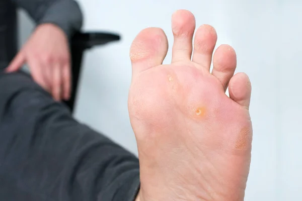 Foot with corns, calluses and dry skin, wart plantar verrucas. Verrucas papilloma callus virus, desease on foot skin. Unhealthy foot leg with corn close up. Man shows callosity before treatment.