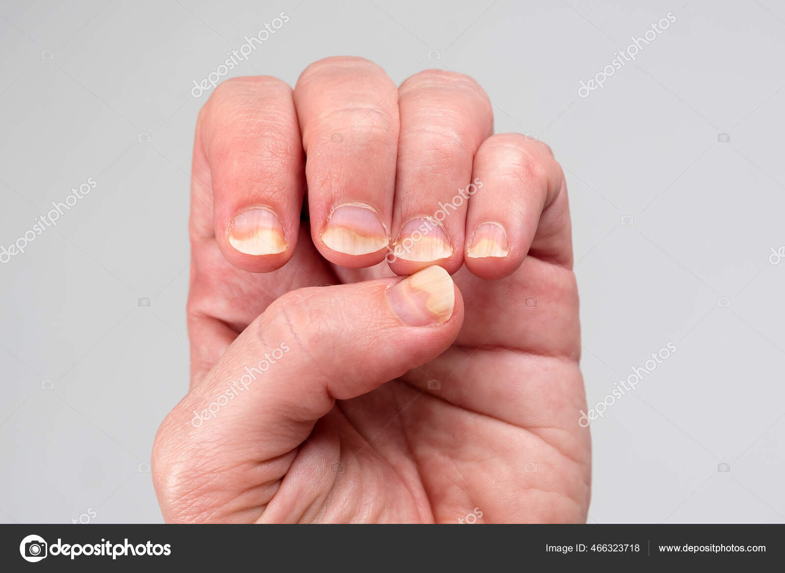 I damaged my nail bed a while back by hitting it on something. It healed  fine, but I noticed the bottom of my nail starting to peel. I kept picking  at it