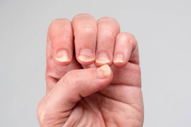 Onychomycosis or fungal nail infection on damaged nails after gel polish, onychosis. Longitudinal ridging nails with psoriasis. Nail diseases, health and beauty problem clipart