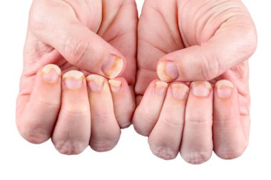 Onychomycosis or fungal nail infection on damaged nails after gel polish, onychosis. Longitudinal ridging nails with psoriasis isolated on white, nail diseases. Health and beauty problem. clipart