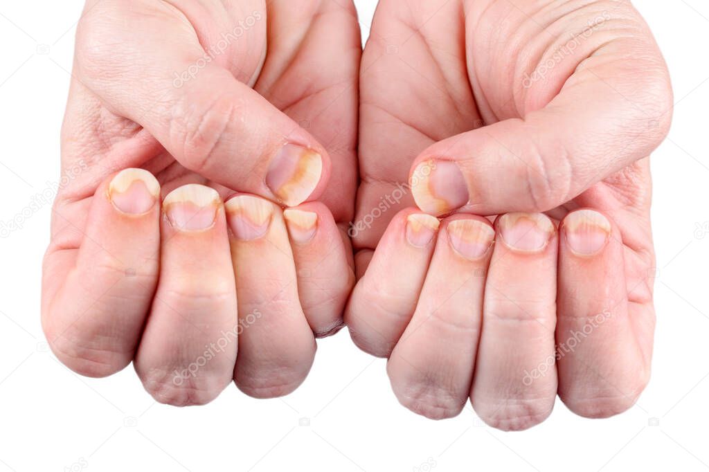 Onychomycosis or fungal nail infection on damaged nails after gel polish, onychosis. Longitudinal ridging nails with psoriasis isolated on white, nail diseases. Health and beauty problem.