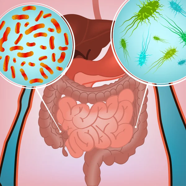 Imagen de infección intestinal — Vector de stock