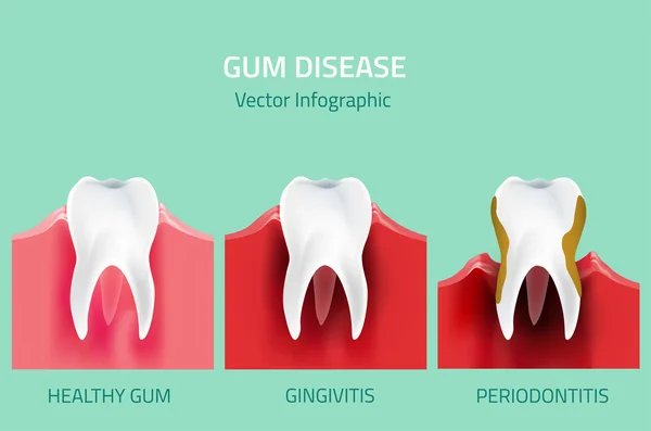 Estágios da doença das gengivas. Infográfico de dentes —  Vetores de Stock