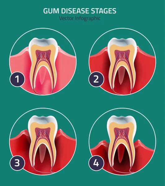 Gum disease vector — Stock Vector