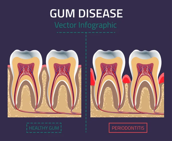 Gum disease vector — Stock Vector