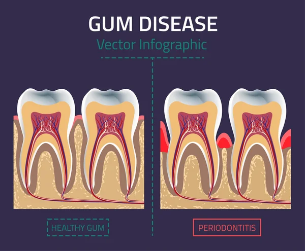 Enfermedad de las encías vector — Archivo Imágenes Vectoriales