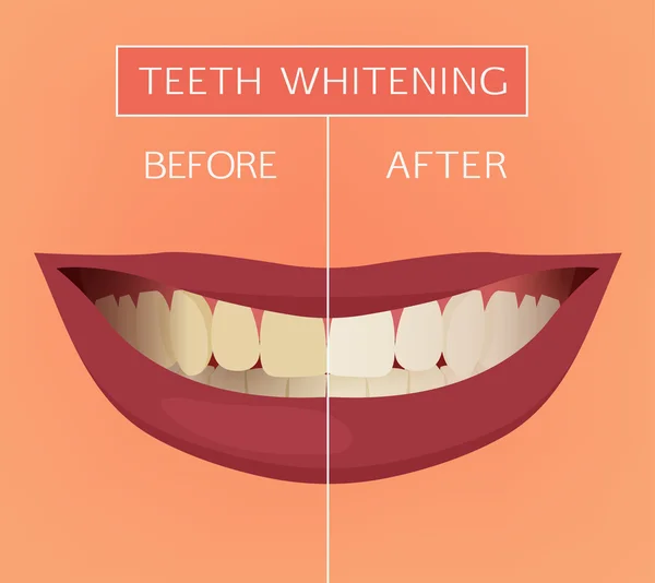 Teeth vector Whitening — Stock Vector