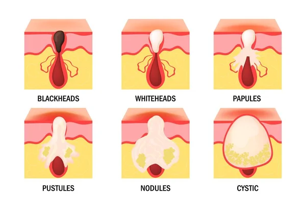 Conjunto de tipos de acne. Doenças da pele, dermatologia, conceito de cosmetologia. —  Vetores de Stock