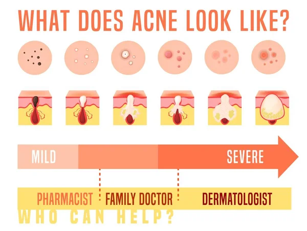 Tipos de acné establecidos. Enfermedad de la piel, dermatología, concepto cosmetológico. — Vector de stock