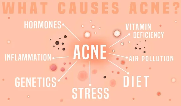 Lo que causa el acné cartel. Enfermedad de la piel, dermatología, concepto cosmetológico. — Vector de stock