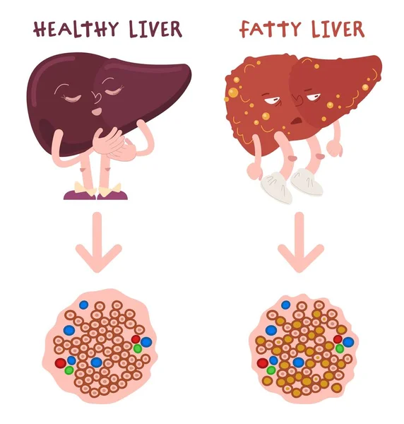 Egészséges és zsíros máj különbség. Tűzoltóság. Májsteatosis. — Stock Vector