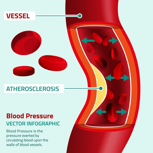 Pressione sanguigna Infografica — Vettoriale Stock