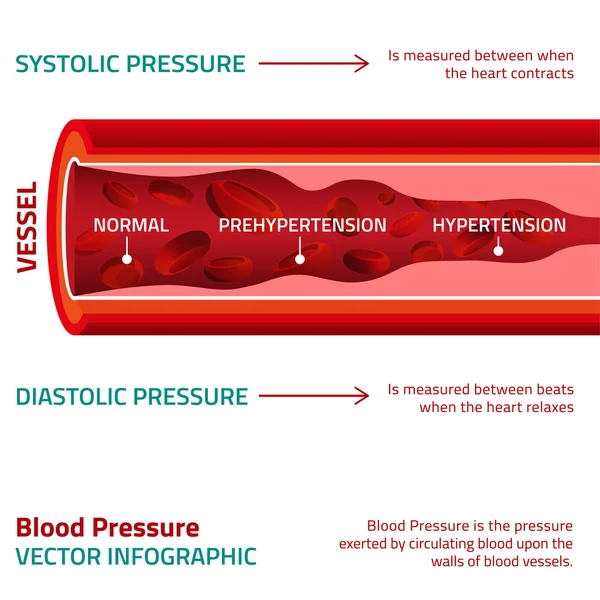 Blood Pressure Infographic — ストックベクタ