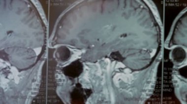 Kafanın MRI taraması. Birinci şahıs görüşü. Resim büyük bir kist ve kemik kusurunu gösteriyor..