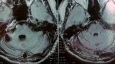 Kafanın MRI taraması. Birinci şahıs görüşü. Resim büyük bir kist ve kemik kusurunu gösteriyor..