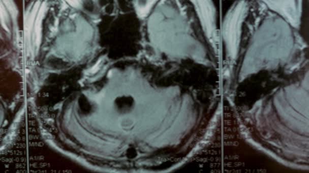 Resonancia magnética de la cabeza. Vista en primera persona. La imagen muestra un gran quiste y defecto óseo. — Vídeo de stock