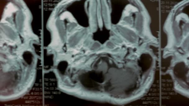 頭部のMRIスキャン。一人称視点。写真は大きな嚢胞と骨の欠陥を示しています. — ストック動画
