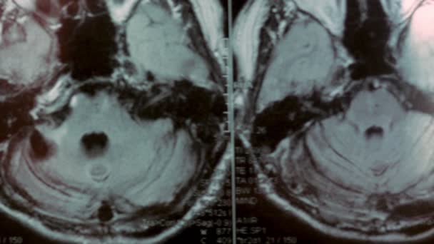 Ressonância magnética da cabeça. Vista em primeira pessoa. A imagem mostra um grande cisto e defeito ósseo. — Vídeo de Stock