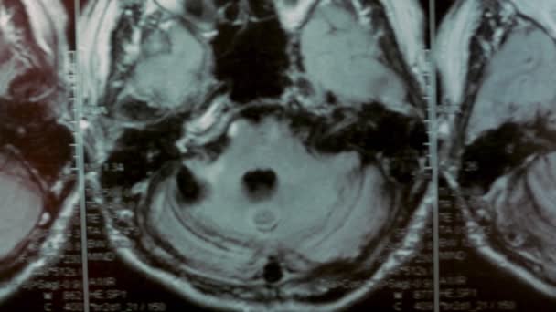 頭部のMRIスキャン。一人称視点。写真は大きな嚢胞と骨の欠陥を示しています. — ストック動画