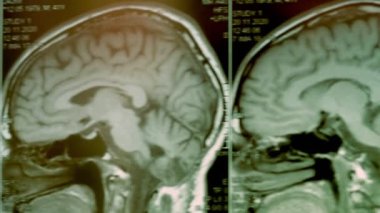 Kafanın MRI taraması. Birinci şahıs görüşü. Resim büyük bir kisti gösteriyor.